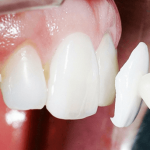 Виниры из керамики Е–max